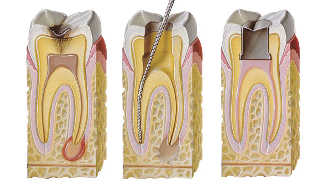 endodonzia-dentista-casotto-niguarda-milano